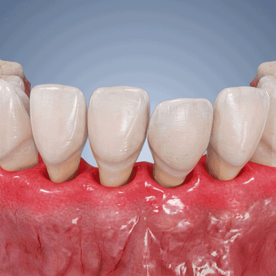 🔥Purelora® GumRevive periodontal repair gel