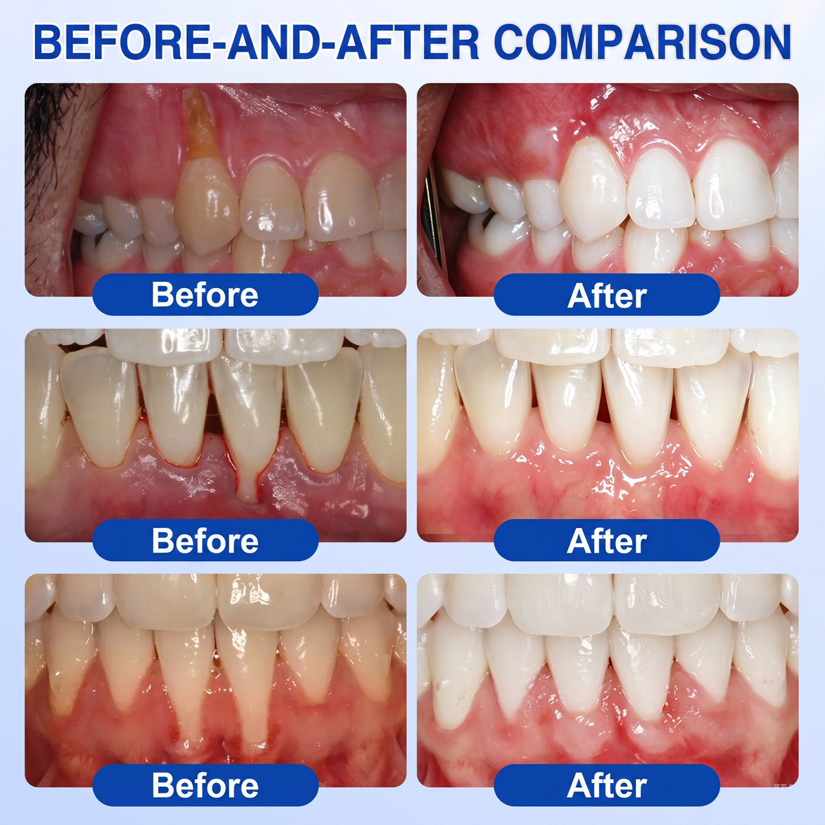 🔥Purelora® GumRevive periodontal repair gel