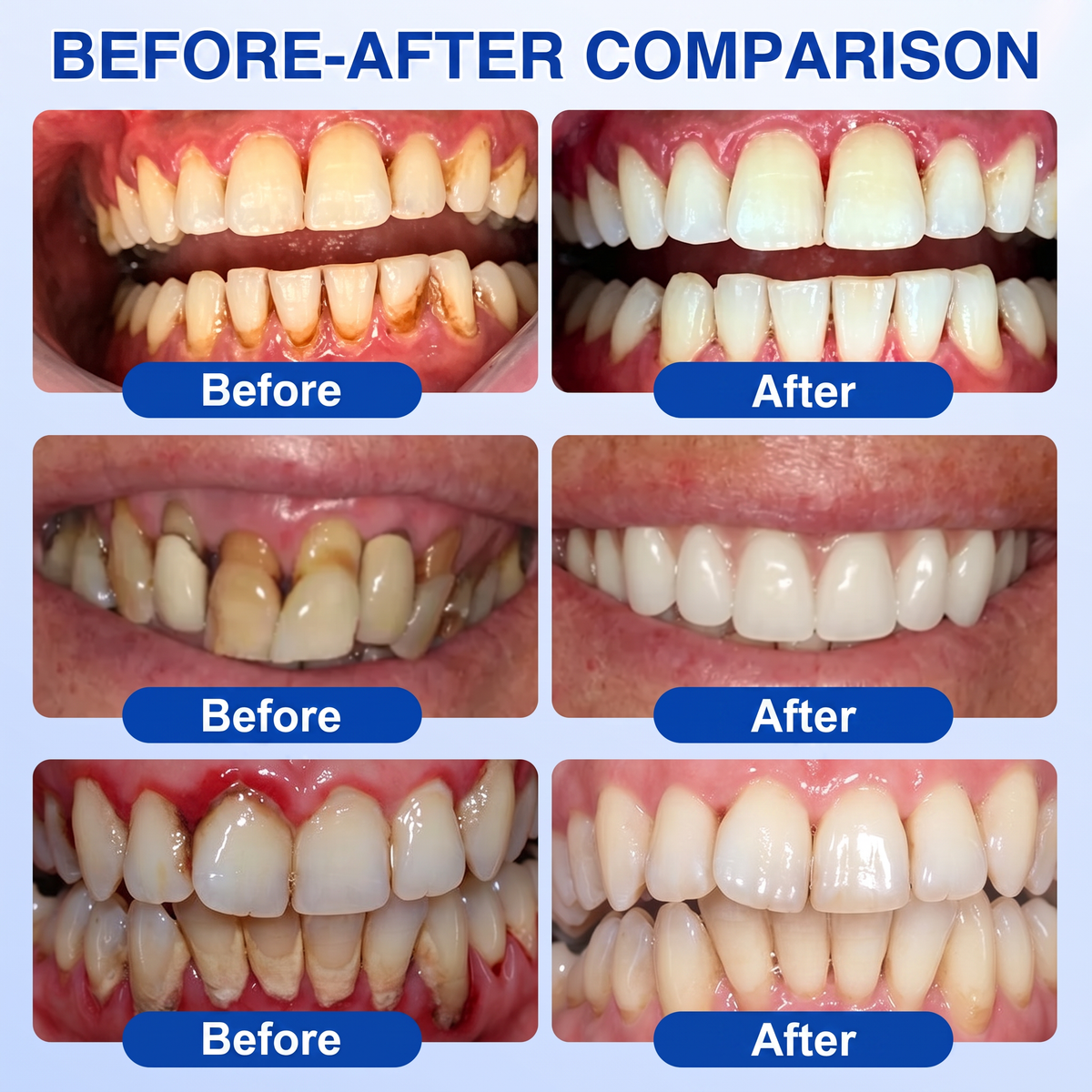 🔥Purelora® GumRevive periodontal repair gel